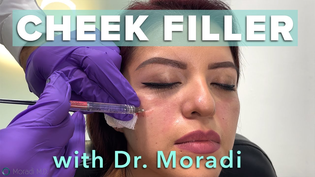 Watch This Patient Get Cheek Filler! Before & After Restylane Contour